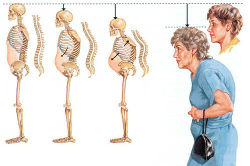 Ở người già, trong khoang xương có chứa gì?